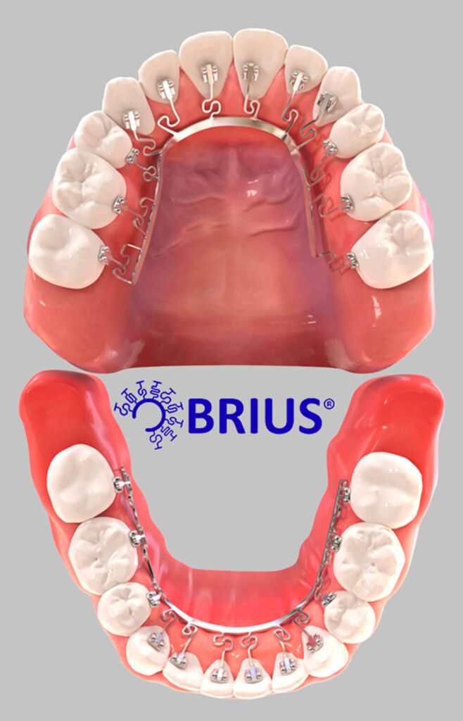 Brius (lingual braces) system on top and bottom teeth