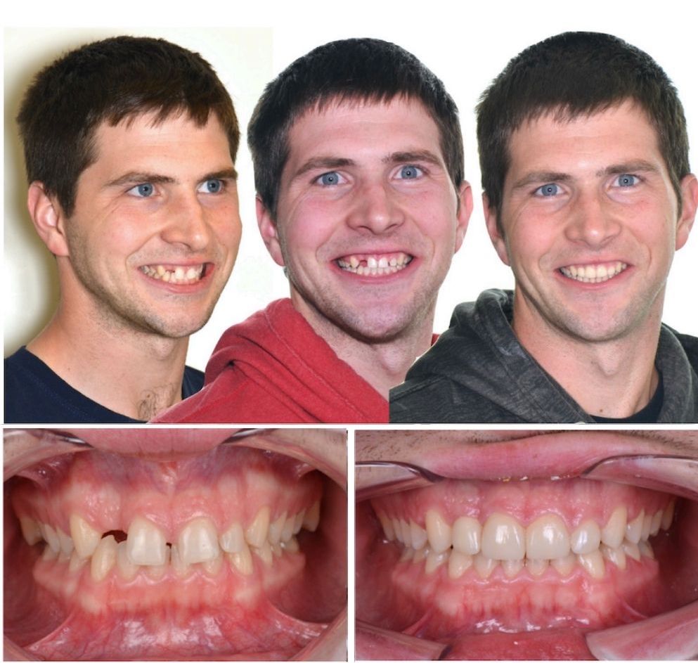 before and after braces pictures of our patient doug