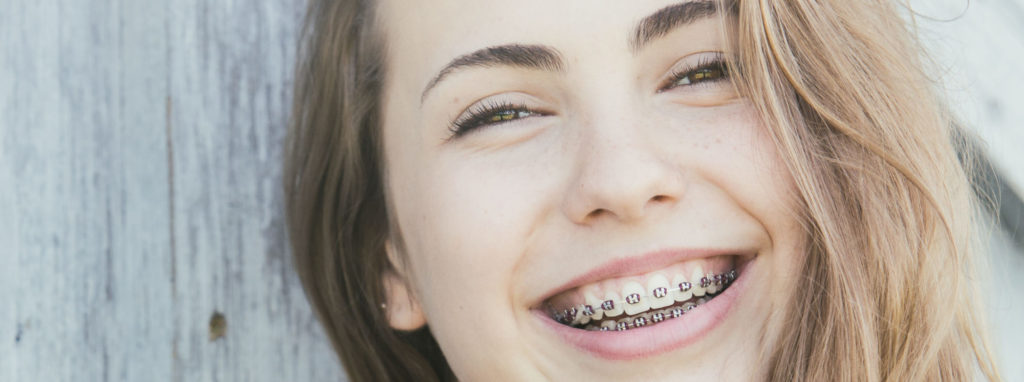 teen with black triangles teeth smiles with her braces on