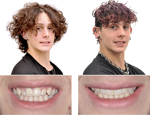 Before-and-After Braces & Invisalign  Matsumoto Orthodontics & Periodontics