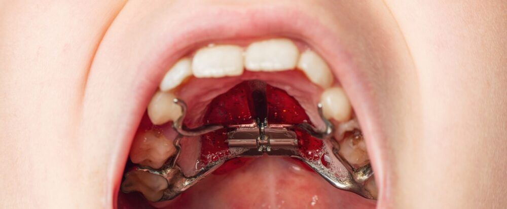 Types of Palatal Expanders