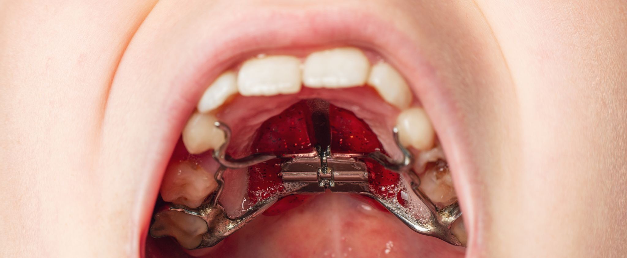 Types of Palatal Expanders