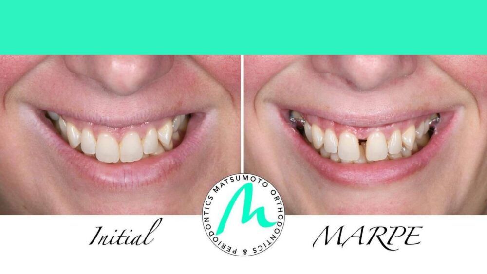 MARPE-Before-and-After