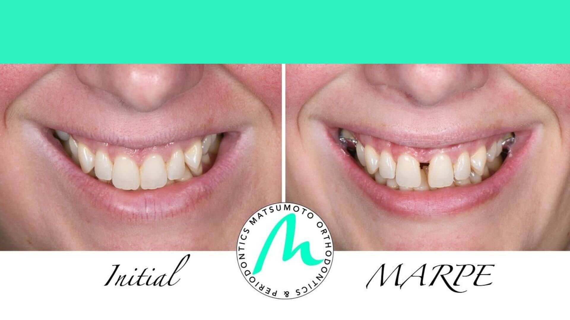 MARPE-Before-and-After